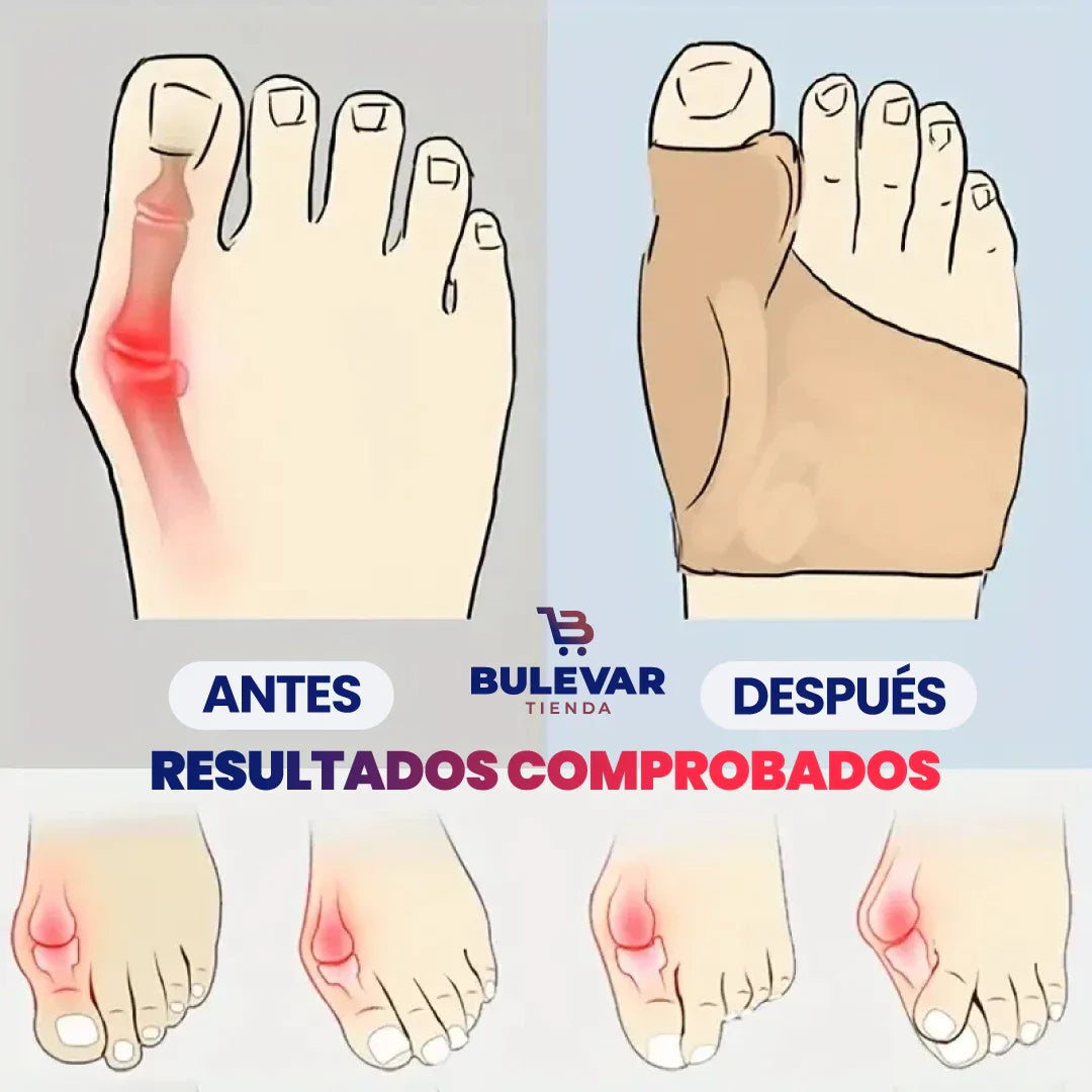 OLVÍDATE DEL DOLOR 🦶- CORRECTOR ORTOPÉDICO DE JUANETES