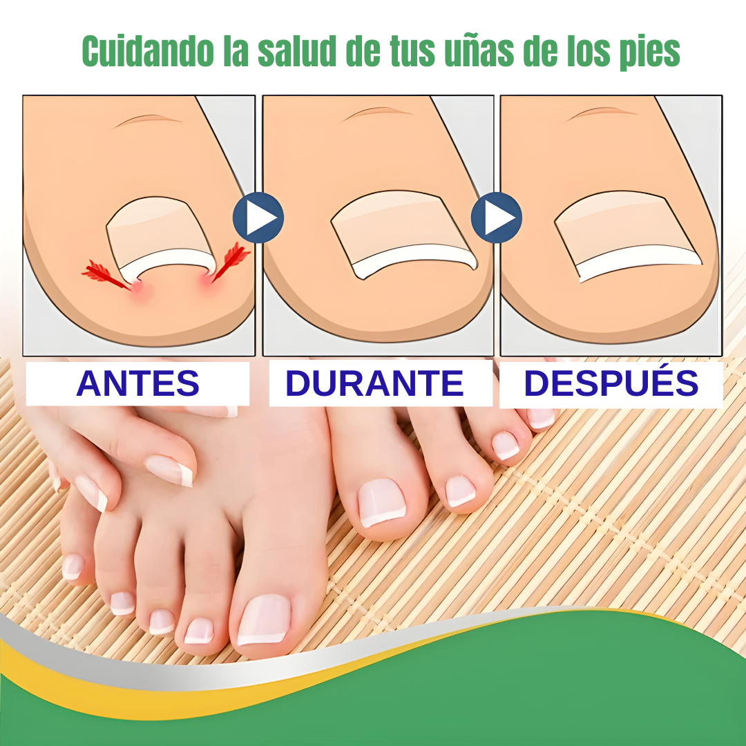 2x1 PARCHE REPARADOR DE UÑA – PROTEGE Y RECUPERA UÑAS ENCARNADAS